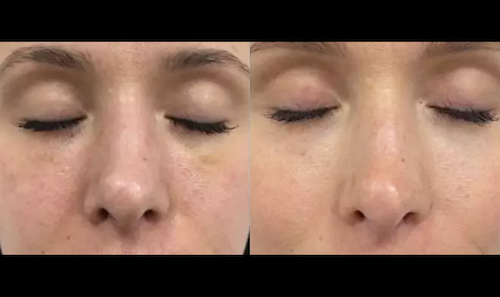 mesotherapy facial rejuvenation before after mississauga oakville